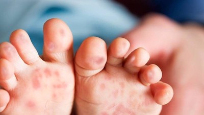 Bệnh tay chân miệng trẻ em điều trị thế nào? Chuyên gia Lê Văn Nhân giải đáp